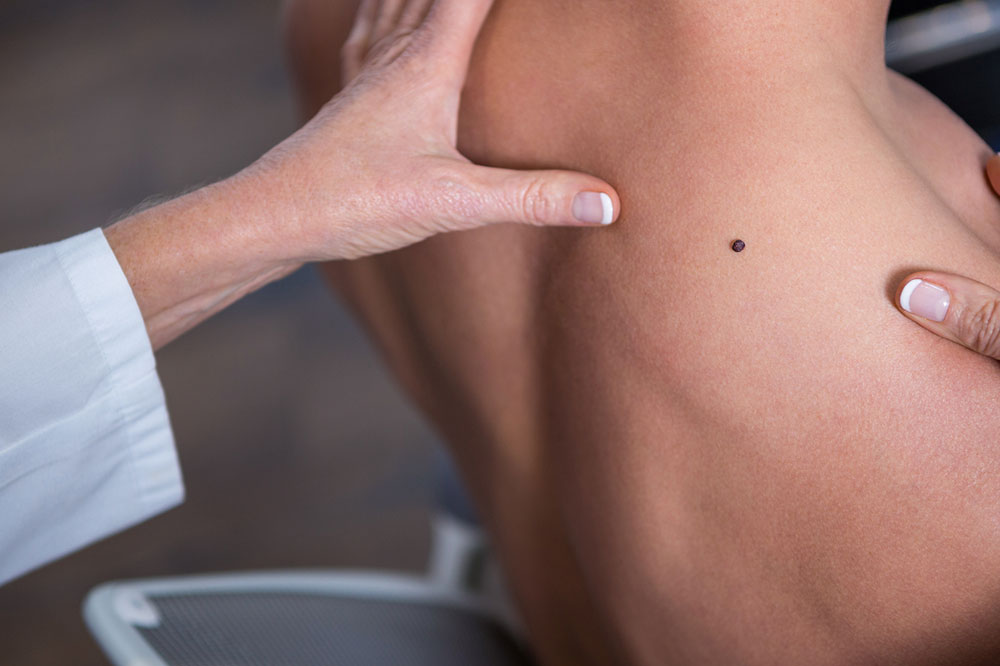 7 Risk Factors That Can Cause Melanoma