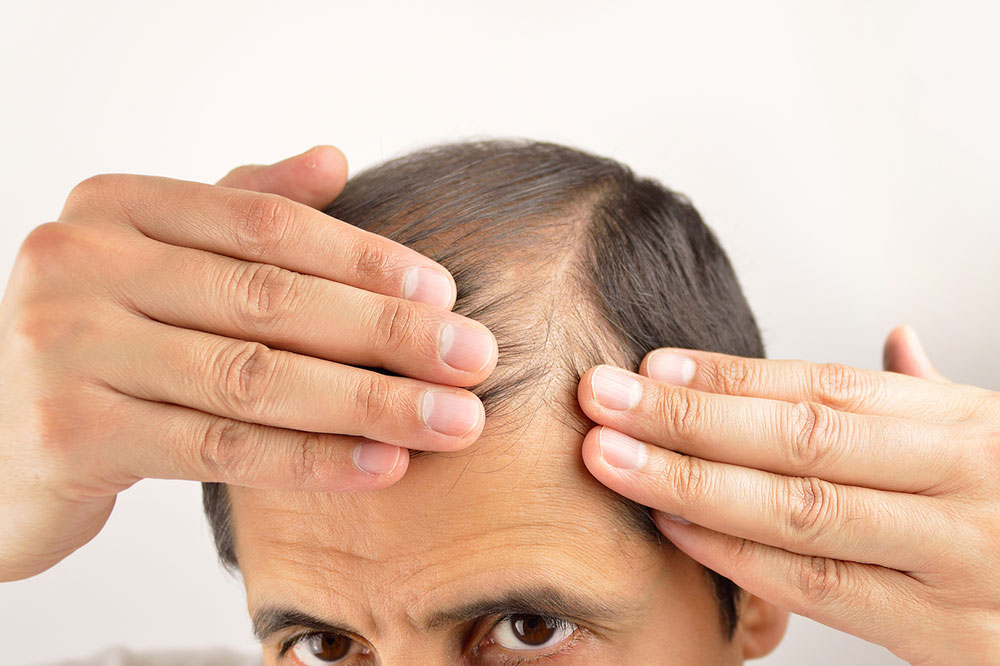 5 Tips to Stop Hair Loss in Men and Women